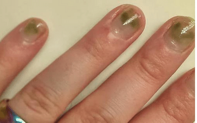 What is Pseudomonas Nail Infection?