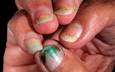 Common signs and symptoms of Pseudomonas nail infection